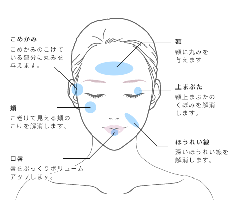 脂肪注入施術イメージ