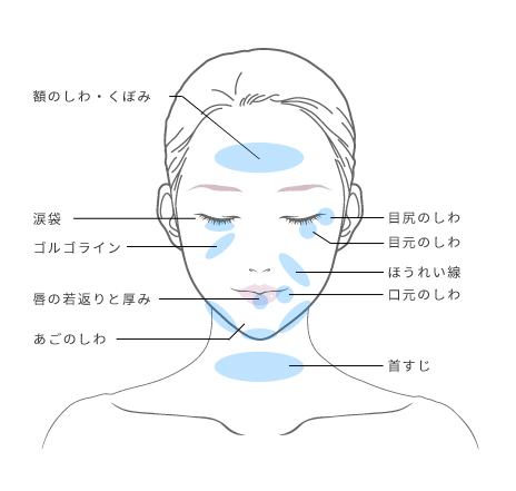 ヒアルロン酸注入施術イメージ