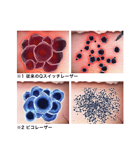 ピコスポット施術イメージ