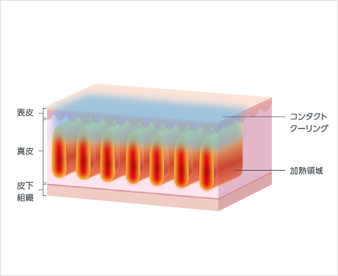 ザーフ・HIFU