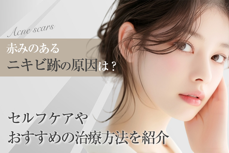 ビフォーアフター有｜赤みのあるニキビ跡の原因は？セルフケアやおすすめの治療方法を紹介