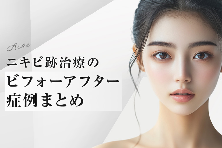 ニキビ跡治療のビフォーアフター症例まとめ