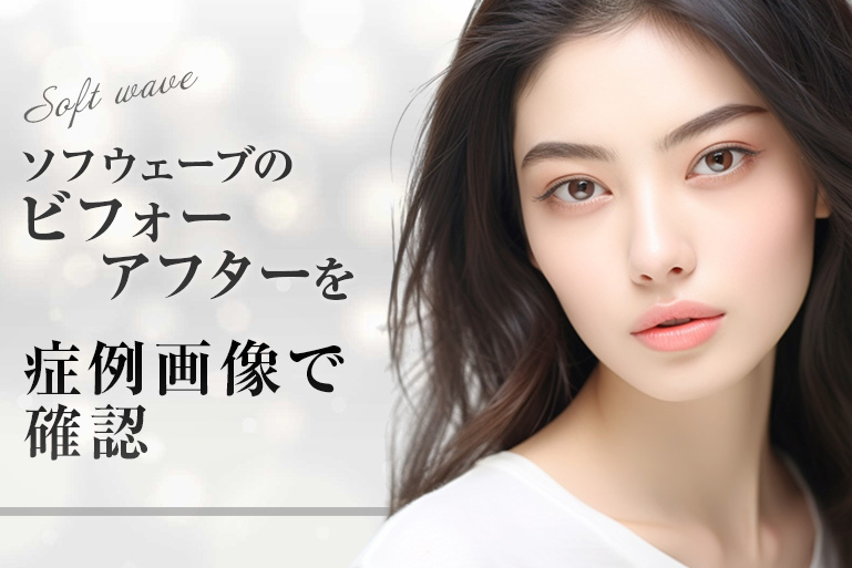 ソフウェーブ 症例 ビフォーアフター