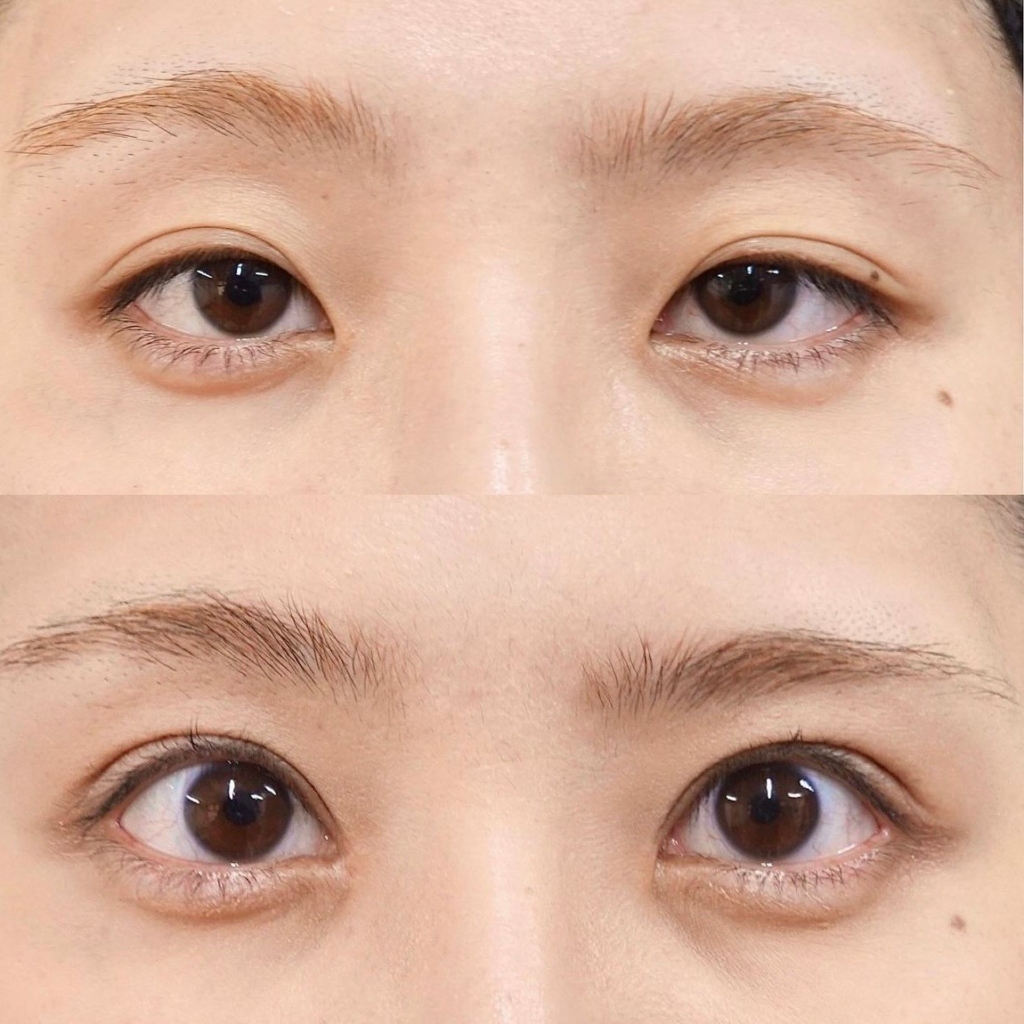 全切開二重術＋眼瞼下垂＋他院修正中度