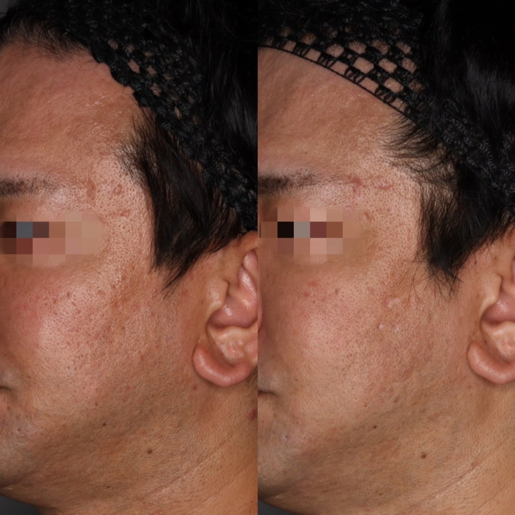 TCAピーリング2回/ミックスピール5回/ダーマペン+PRP5回