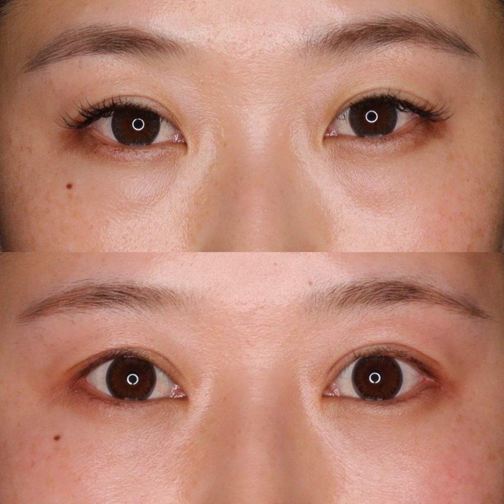 下眼瞼脱脂+グラマラス形成+前切開二重術+眼瞼下垂+他院埋没糸抜糸+目頭切開+目尻切開