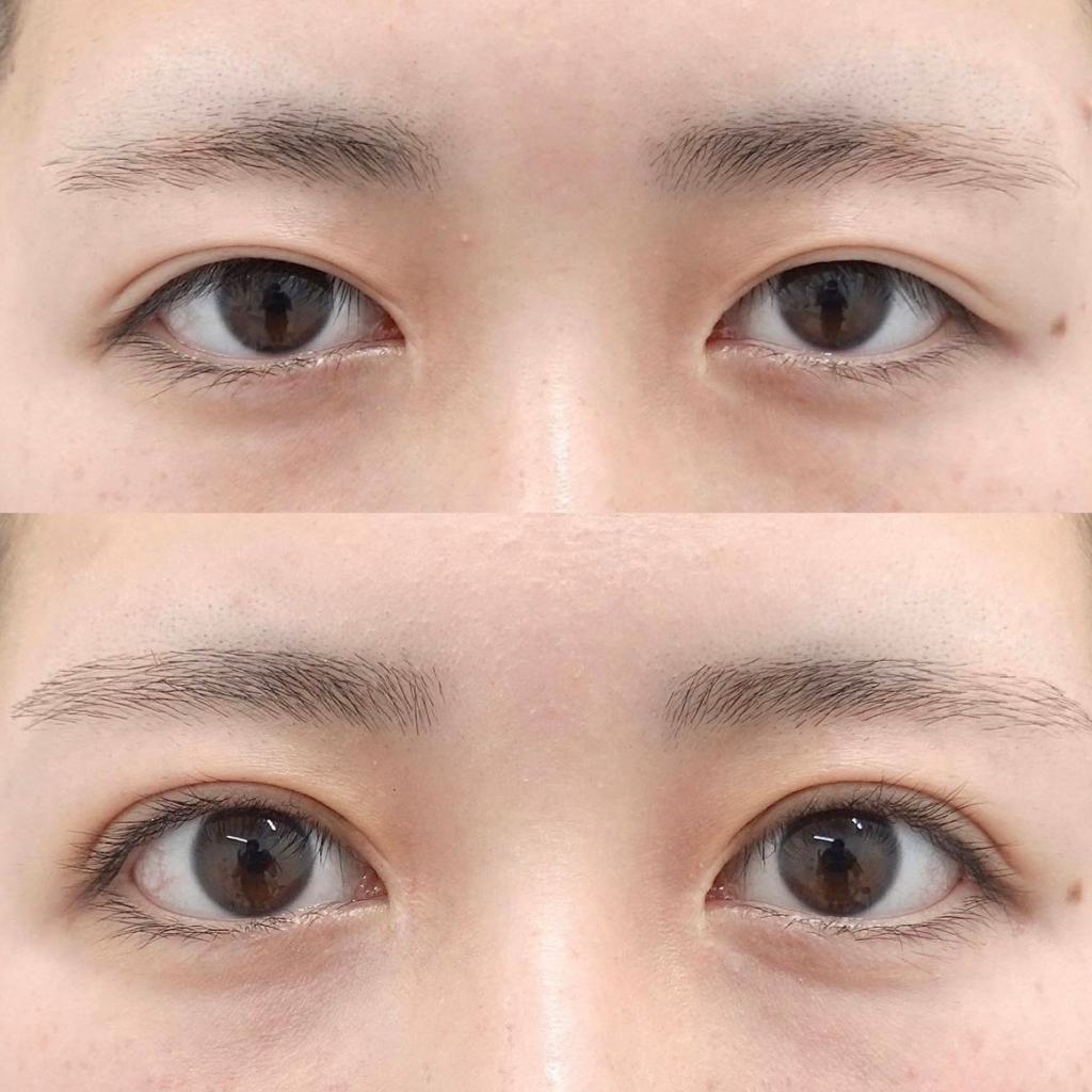 全切開二重術＋眼瞼下垂修正＋目尻切開＋グラマラスライン形成＋目頭切開