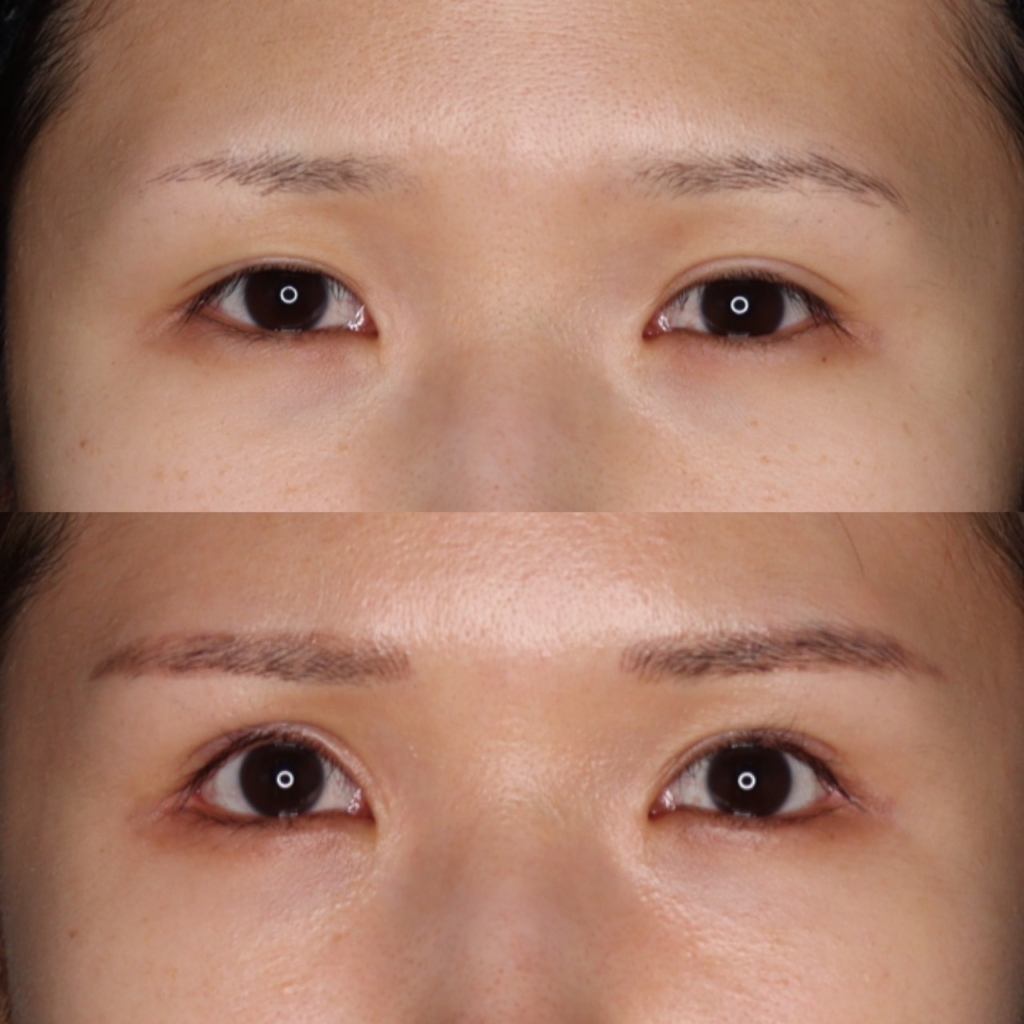 全切開二重術+眼瞼下垂+目尻切開+グラマラスライン（結膜側）