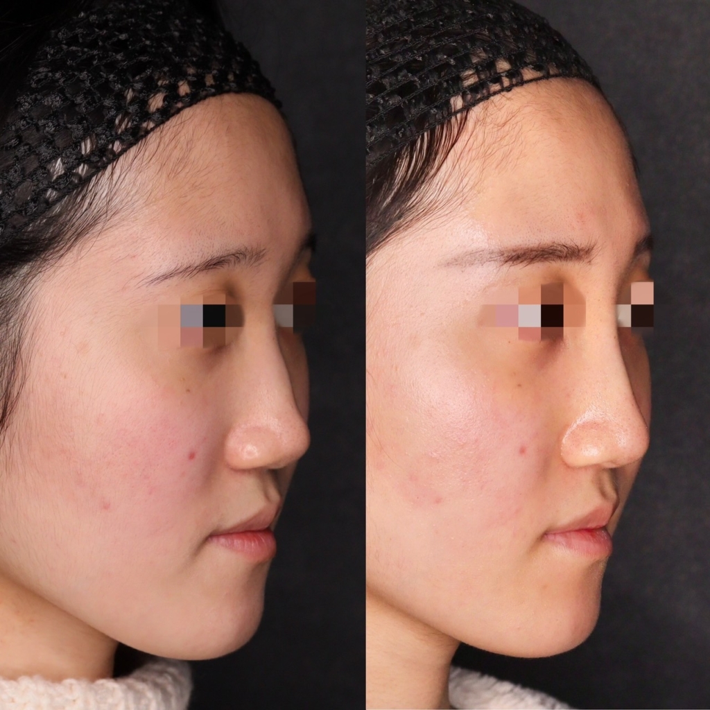 鼻プロテーゼ＋耳介軟骨移植
