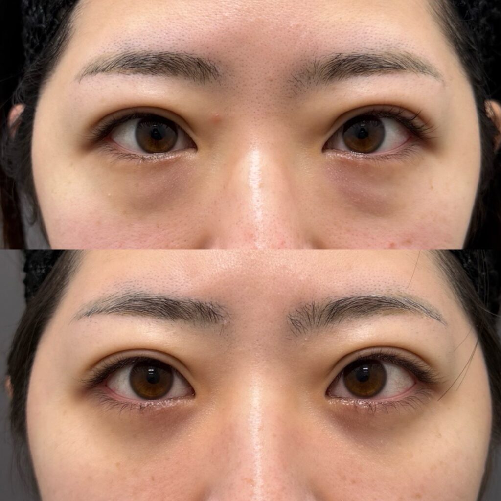 下眼瞼脱脂・脂肪注入（目の下）・ナノリッチ加工・カニューレ・腫れ止め点滴・笑気麻酔・安藤医師指名料
