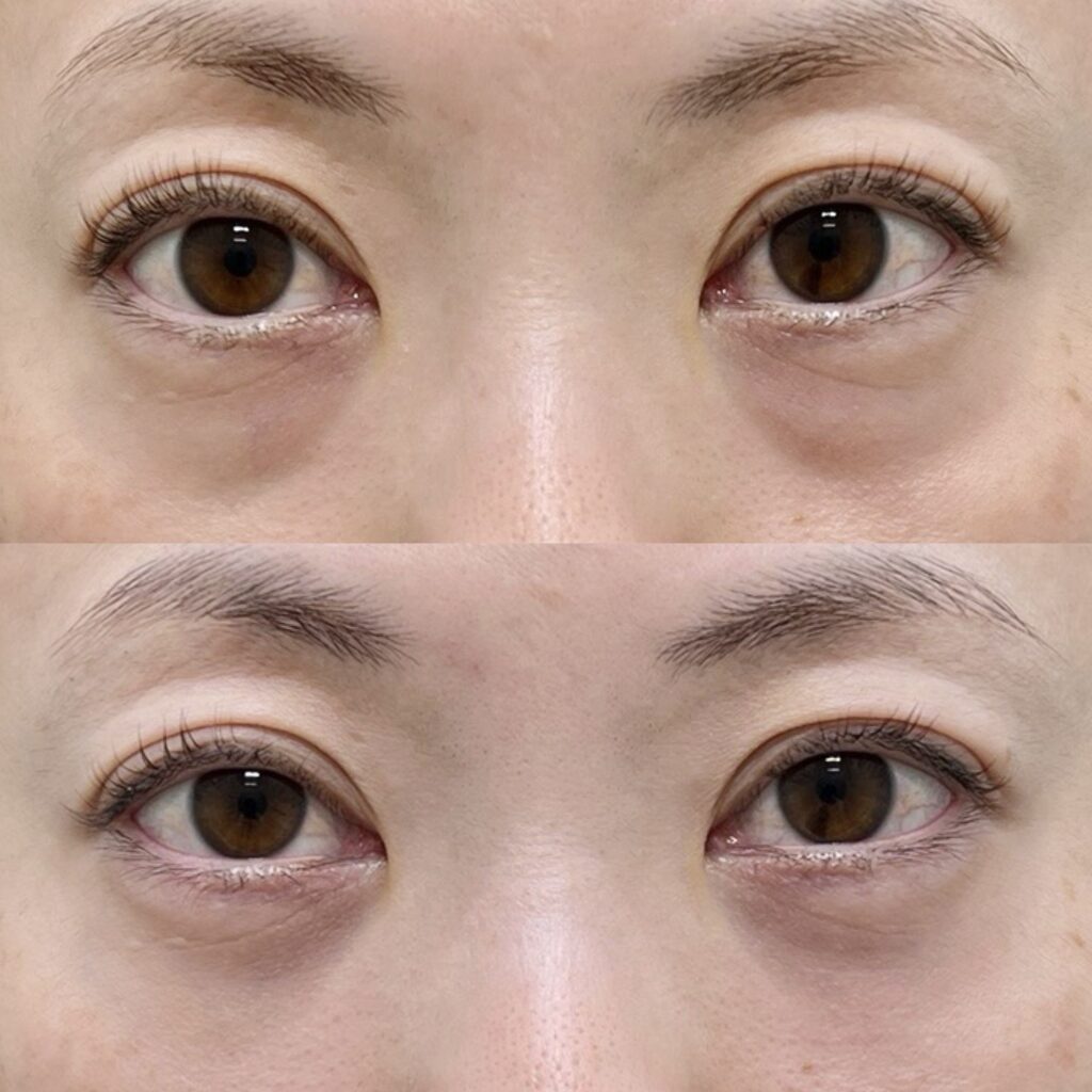 下眼瞼脱脂・笑気麻酔