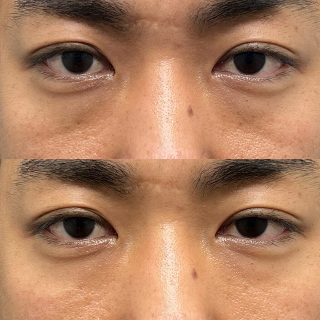 ヒアルロン酸（目の下）・マイクロカニューレ
