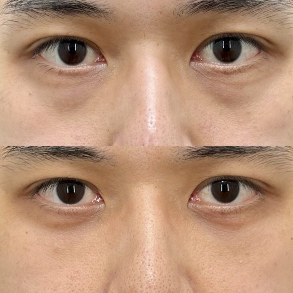 下眼瞼脱脂・脂肪注入（目の下）・ナノリッチ加工・カニューレ・笑気麻酔・安藤医師指名料