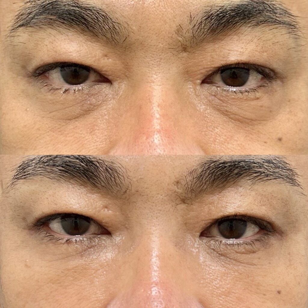 下眼瞼脱脂・脂肪注入（目の下）・ナノリッチ加工・カニューレ・腫れ止め点滴・笑気麻酔・安藤医師指名料