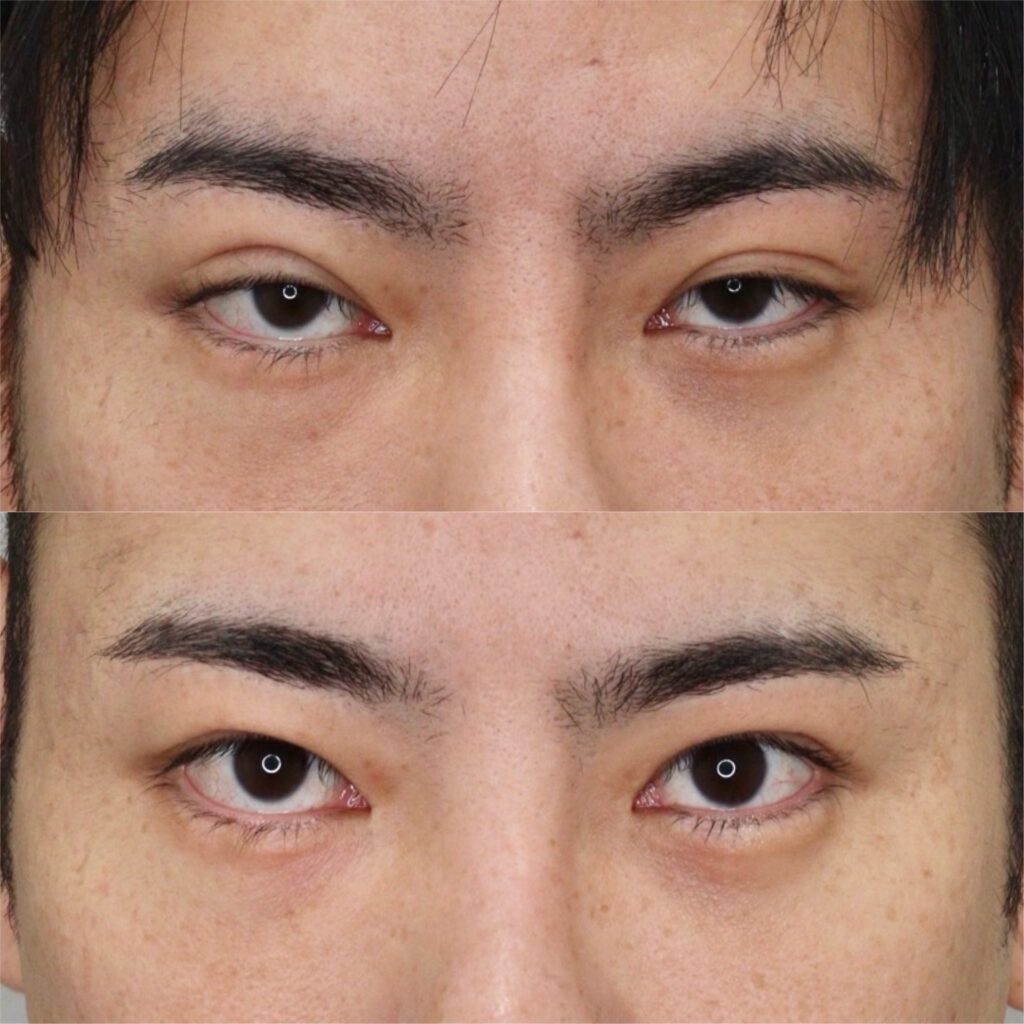 前田式全切開二重術＋眼瞼下垂・他院埋没抜糸・腫れ止め点滴・笑気麻酔