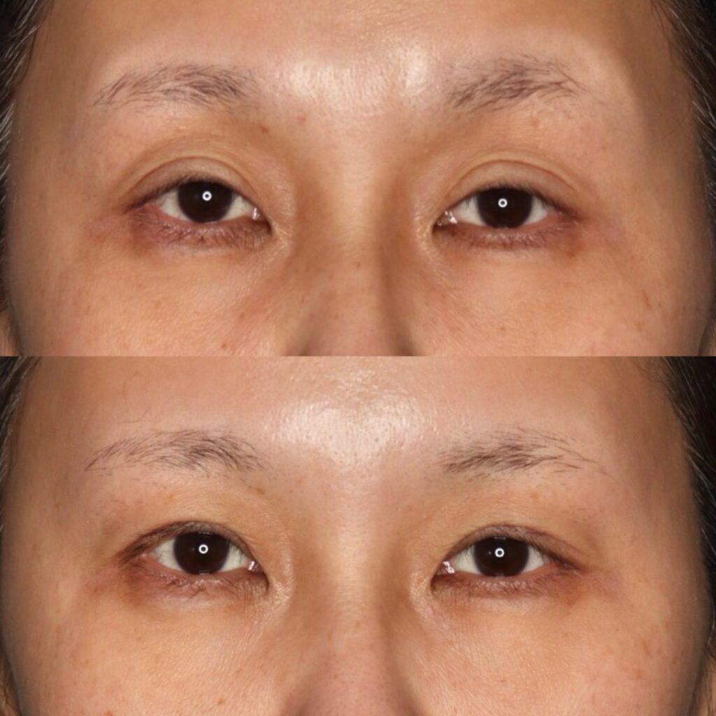 前田式全切開二重術＋眼瞼下垂・他院修正（高度）・笑気麻酔