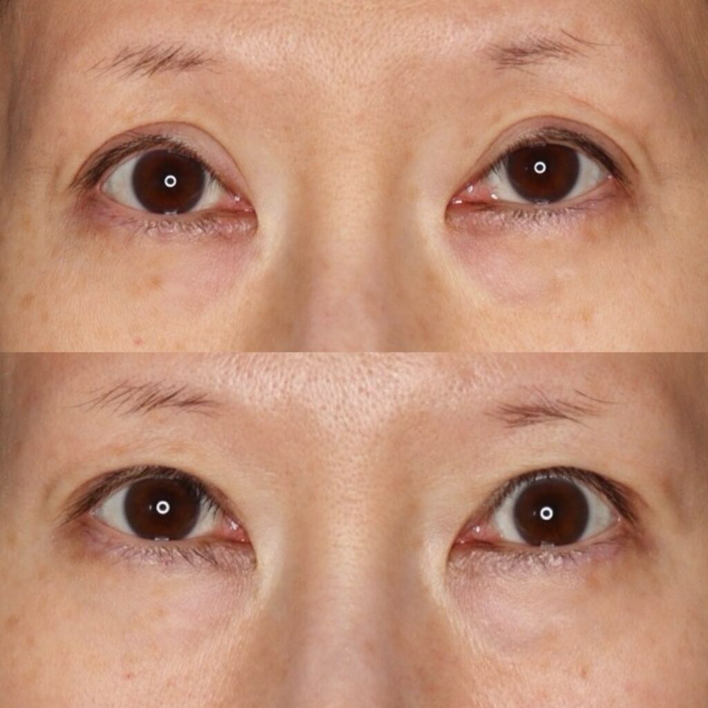 前田式全切開二重術＋眼瞼下垂・他院修正（高度）・笑気麻酔