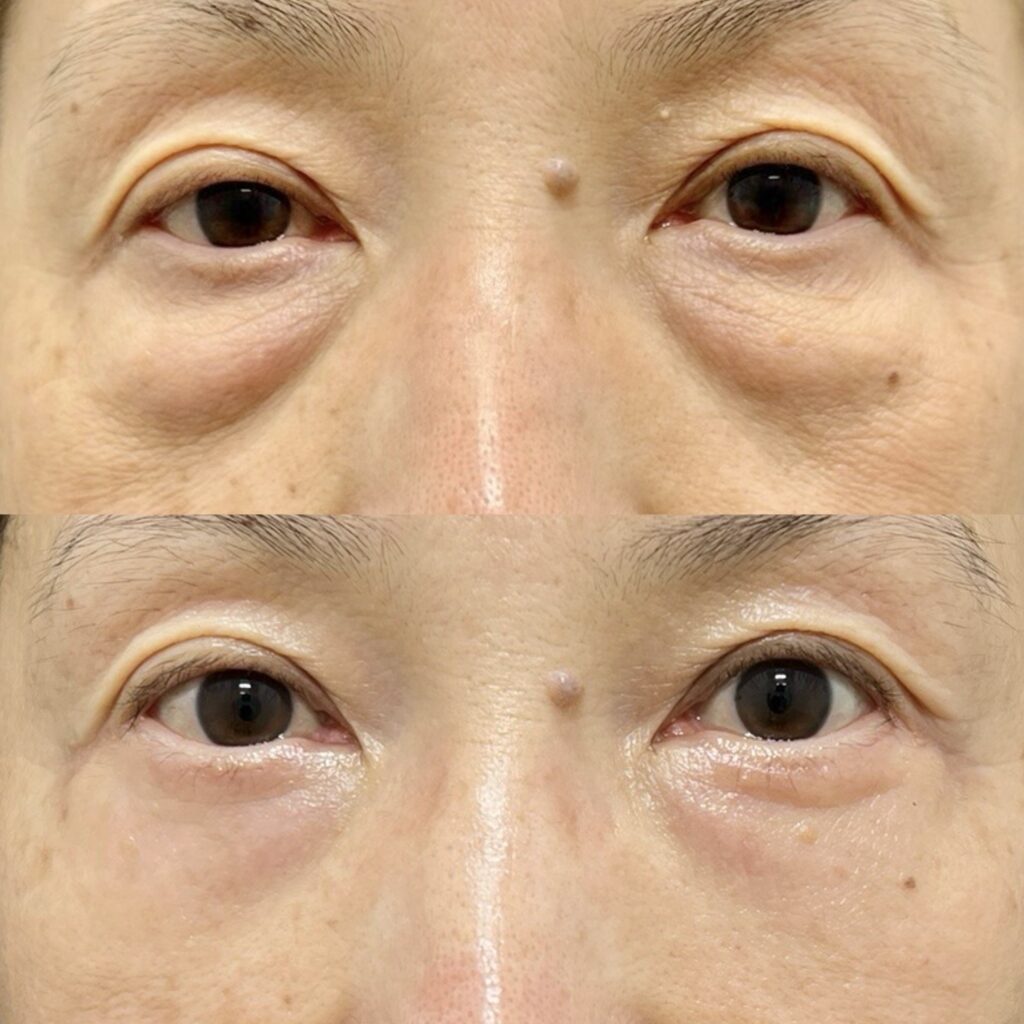 表ハムラ・眼瞼吊り上げ・腫れ止め点滴・静脈麻酔・笑気麻酔