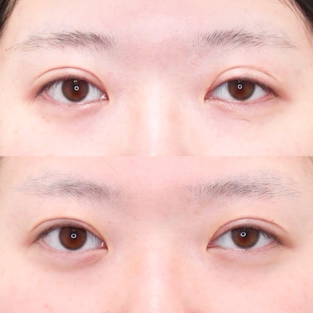 前田式全切開二重術＋眼瞼下垂・他院修正（中度〜高度）・笑気麻酔