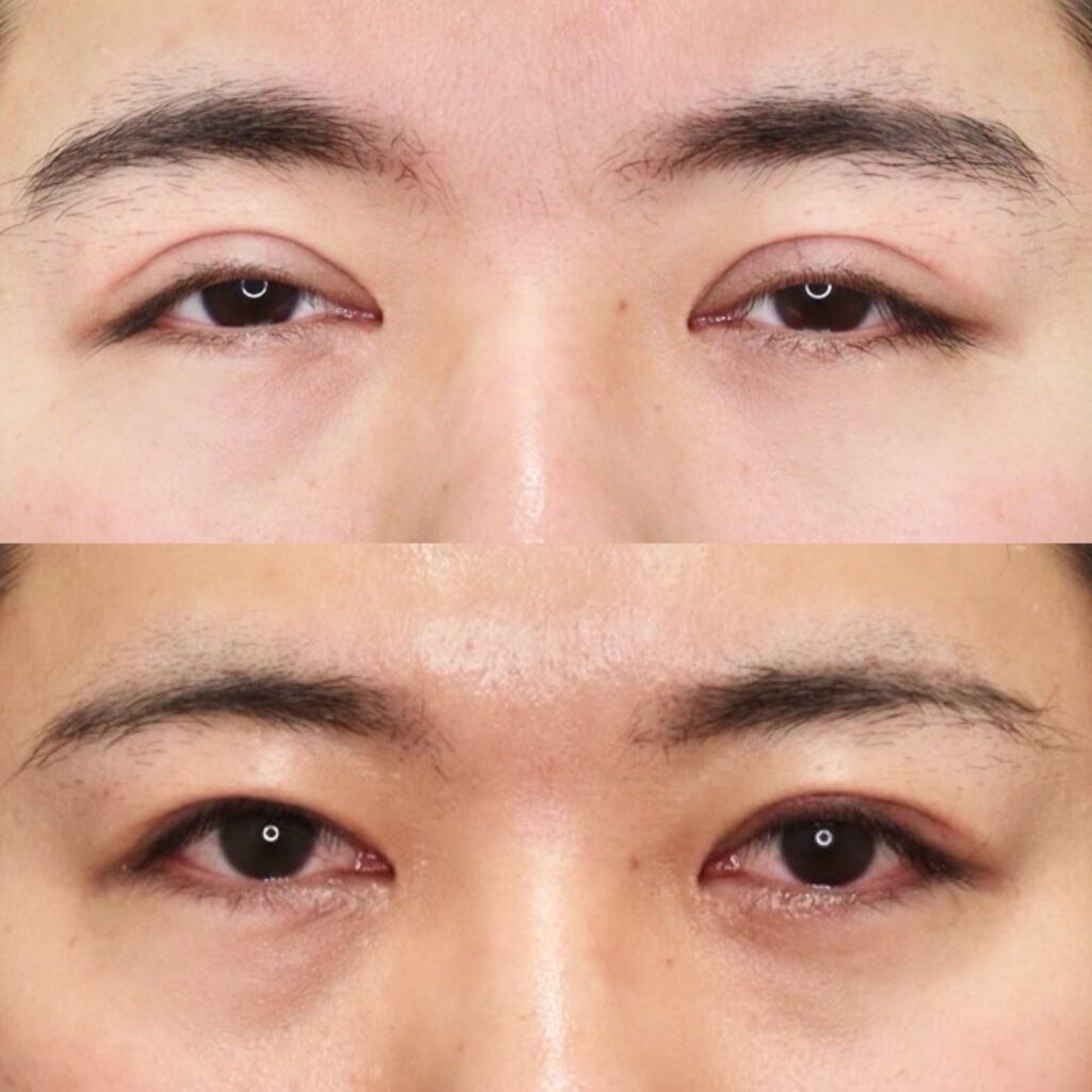 前田式全切開二重術＋眼瞼下垂修正・他院修正（重度）・腫れ止め点滴・笑気麻酔
