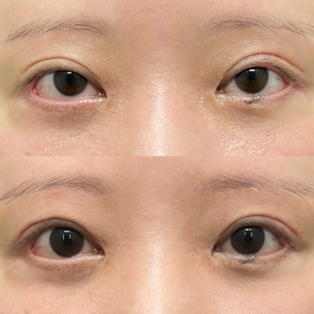 前田式全切開二重術＋眼瞼下垂・他院修正（高度）・笑気麻酔