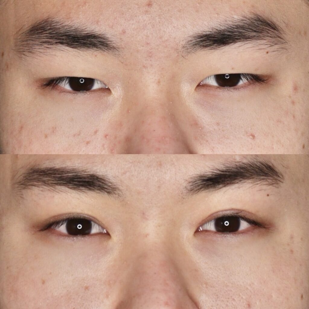 前田式全切開二重術＋眼瞼下垂・腫れ止め点滴・笑気麻酔