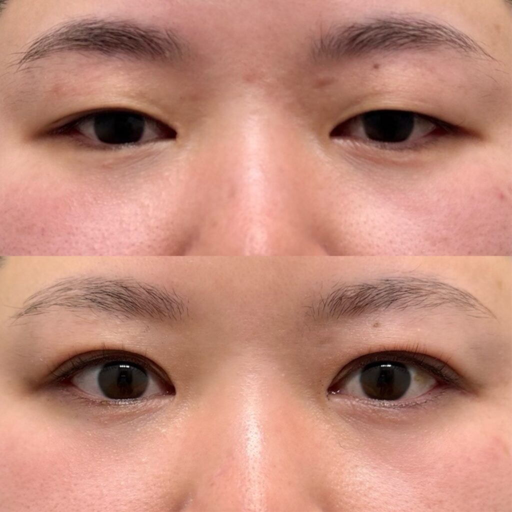 全切開二重術・腫れ止め点滴＋内服セット・笑気麻酔