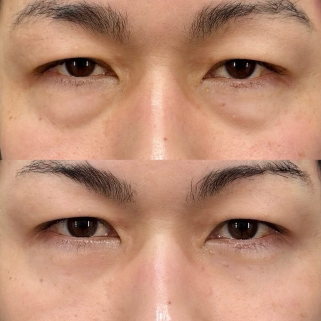 裏ハムラ・腫れ止め点滴＋内服セット・笑気麻酔