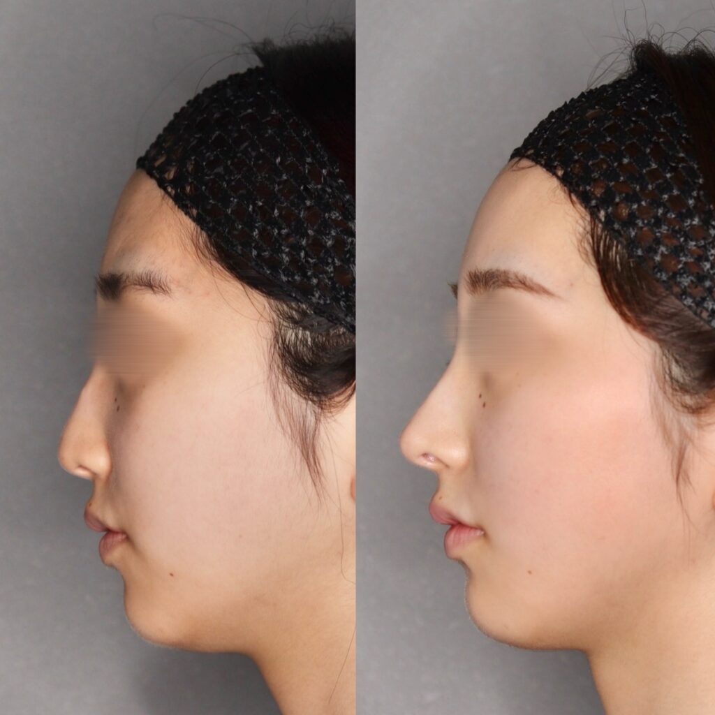 鼻中隔延長（鼻尖形成＋耳介軟骨移植）・固定デンバー・全身麻酔・採血