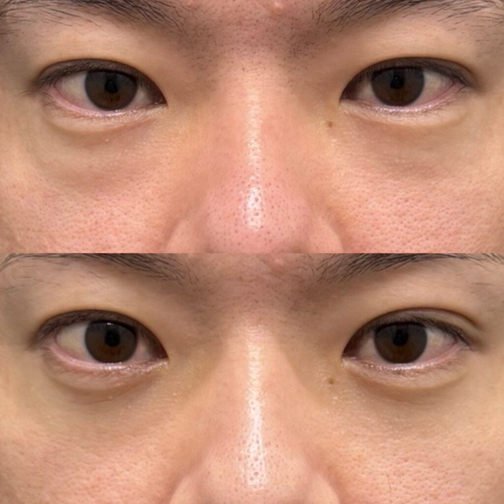 下眼瞼脱脂・笑気麻酔