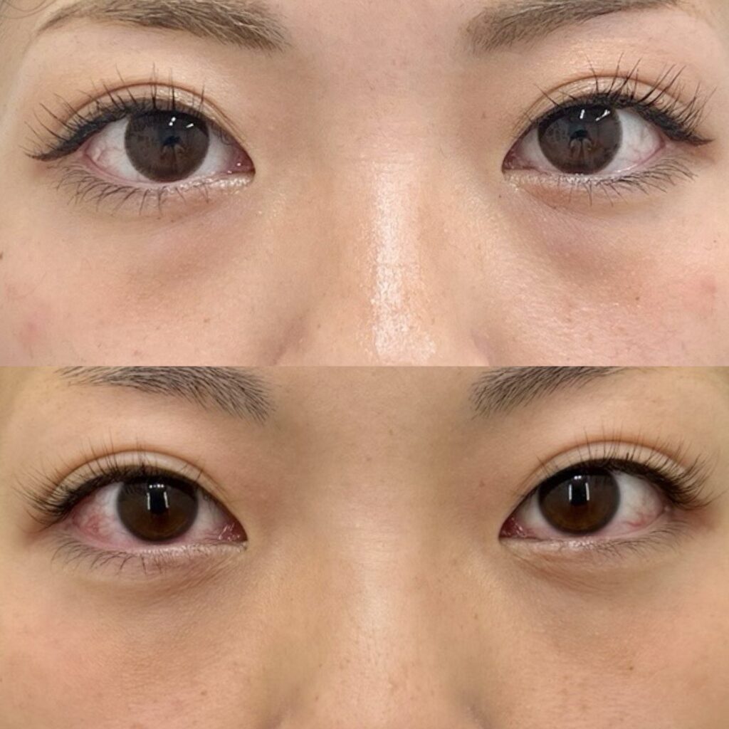 裏ハムラ・ボトックス（顎）・腫れ止め点滴＋内服セット・笑気麻酔