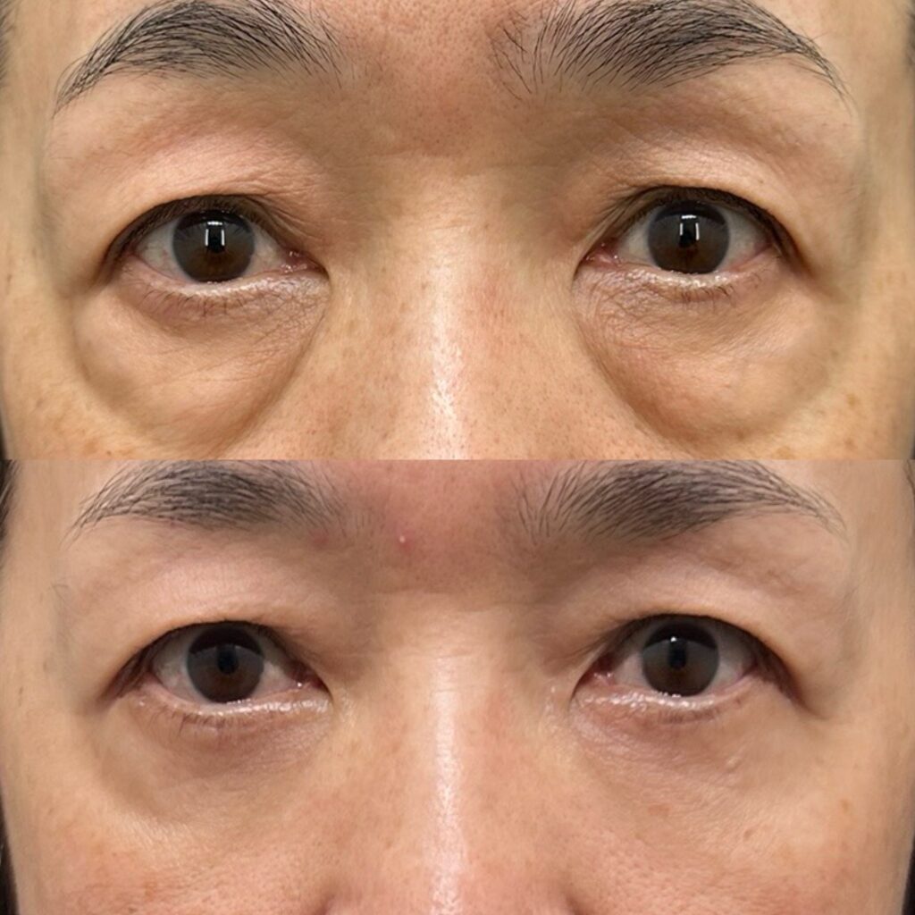 表ハムラ・笑気麻酔