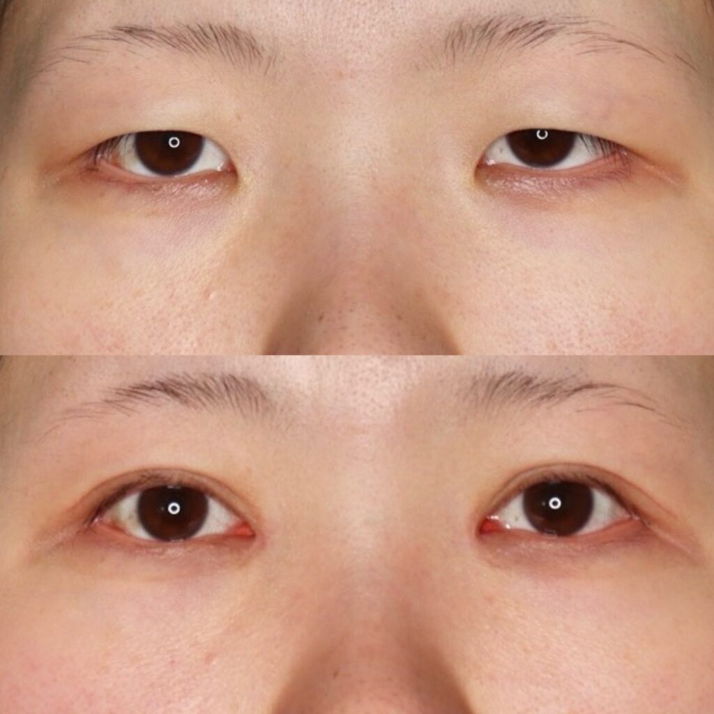 全切開＋眼瞼下垂・ROOF切除・目頭切開・笑気麻酔