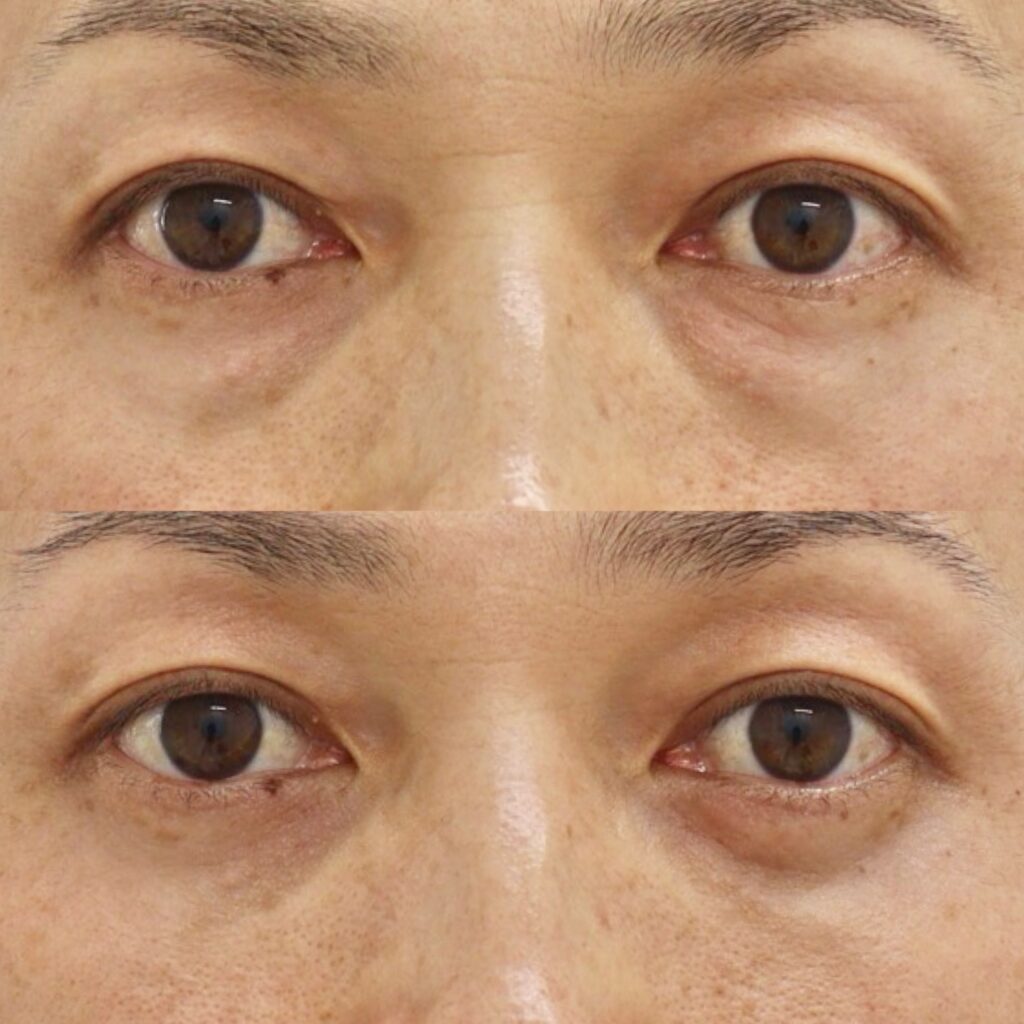 下眼瞼脱脂・笑気麻酔