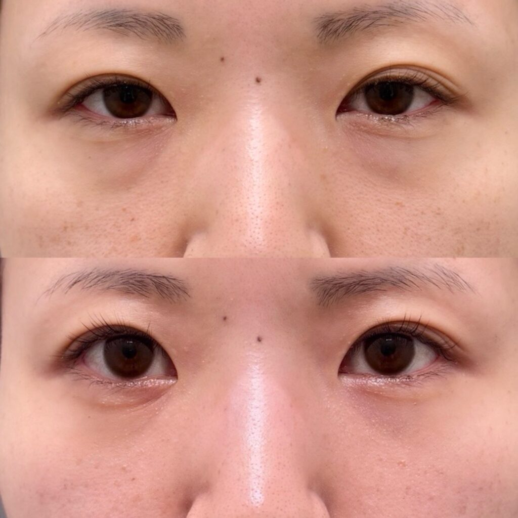 裏ハムラ・ボトックス（エラ）・腫れ止め点滴＋内服セット・笑気麻酔