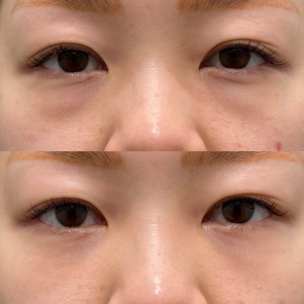裏ハムラ・腫れ止め点滴・笑気麻酔