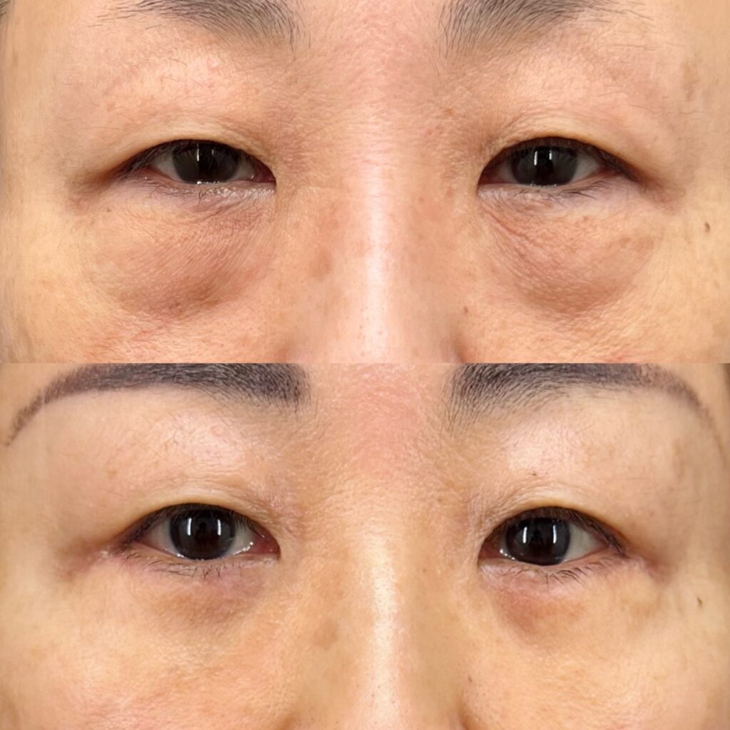 表ハムラ・笑気麻酔